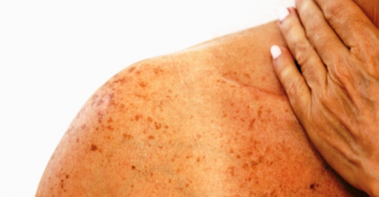 Câncer de pele é tema da campanha Dezembro Laranja