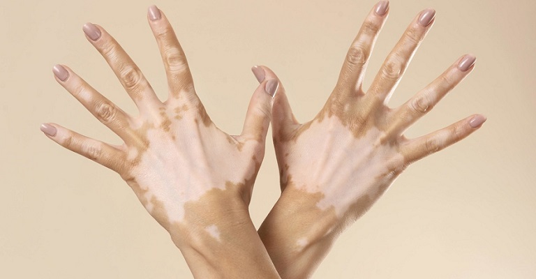 Vitiligo: a informação é o melhor remédio